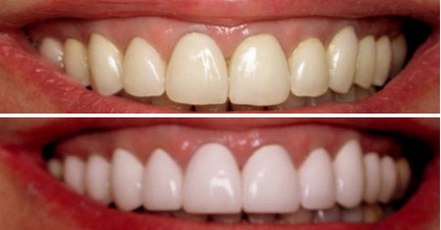 تبييض الأسنان بالليزر بالتفصيل ونصائح واحتياطات هامة معمل